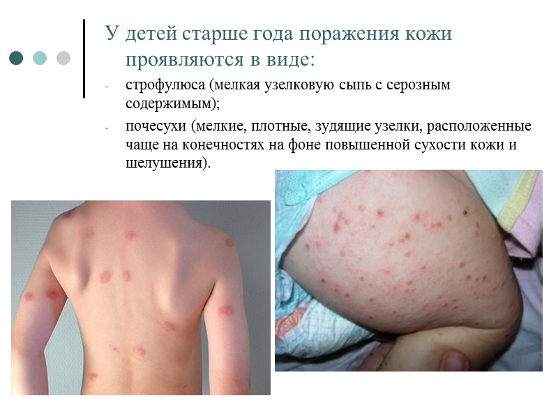 У детей старше года поражения кожи проявляются в виде:  строфулюса (мелкая узелковую сыпь